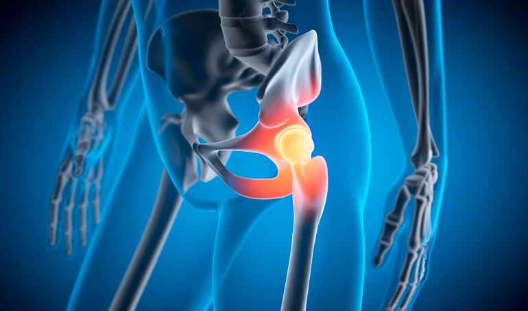 Hip arthritis condition treated with non-surgical pain treatment in Lansing MI