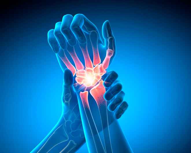 Skeletal figure grabbing wrist in pain depicting osteoarthritis treated with non-surgical joint degeneration treatment in Lansing MI