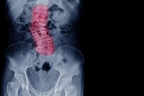 Scoliosis chiropractic care in Lansing MI